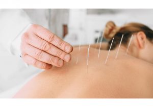 acupuncture pour mal de dos