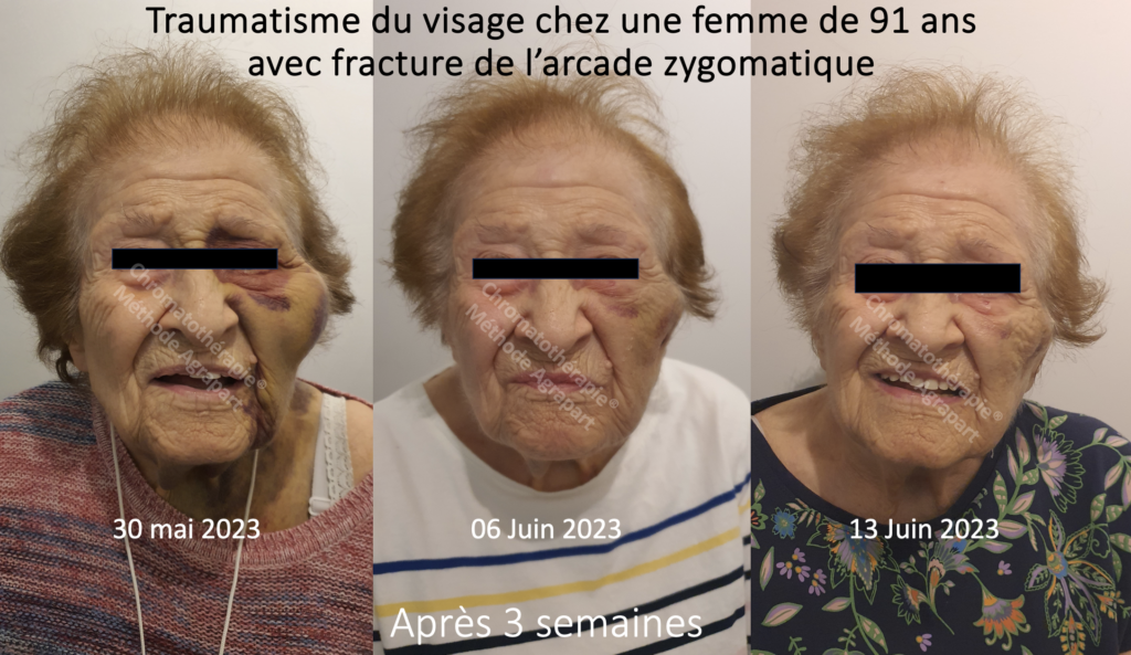 Exemple clinique de la chromatothérapie 